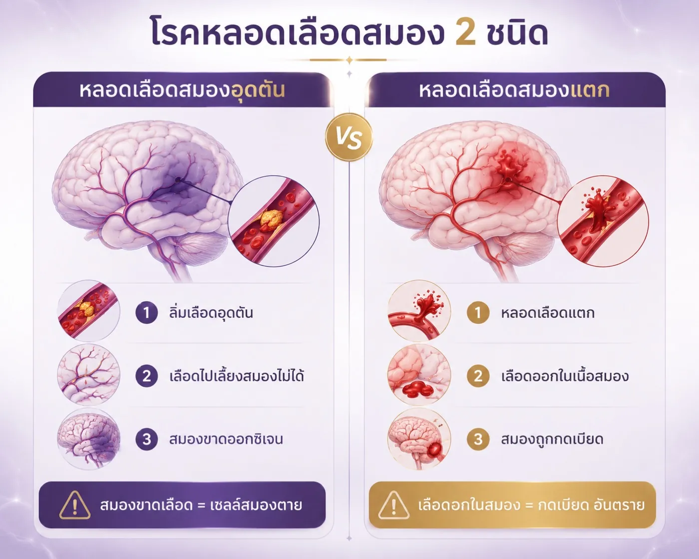 หลอดเลือดสมองอุดตันจากลิ่มเลือด เปรียบเหมือนถนนสายหลักถูกปิด