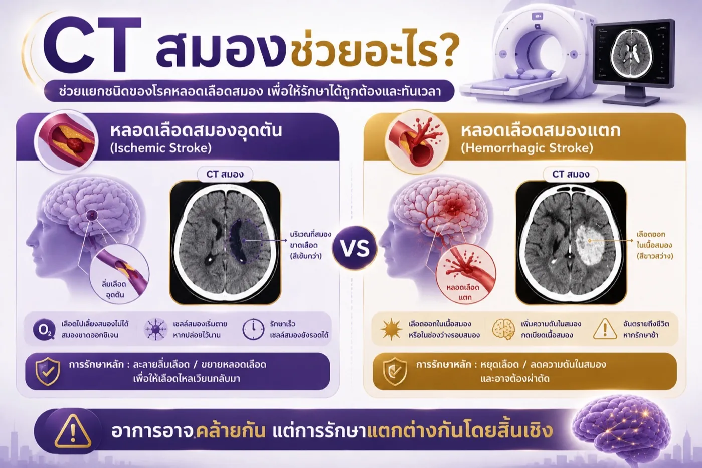 ภาพ CT สมองช่วยแยกหลอดเลือดสมองอุดตันจากหลอดเลือดสมองแตก